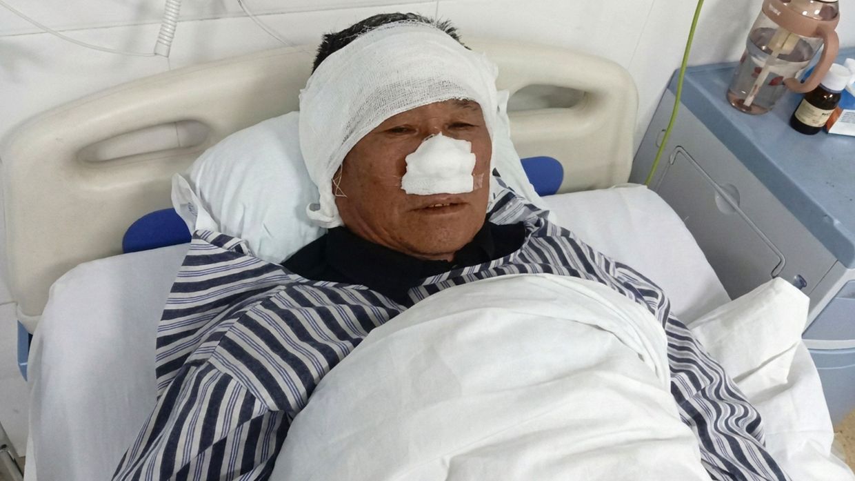 Chinese retiree loses nose saving woman from attacker, honoured as national hero